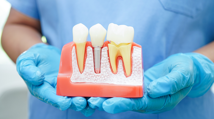 What Are Dental Implants?